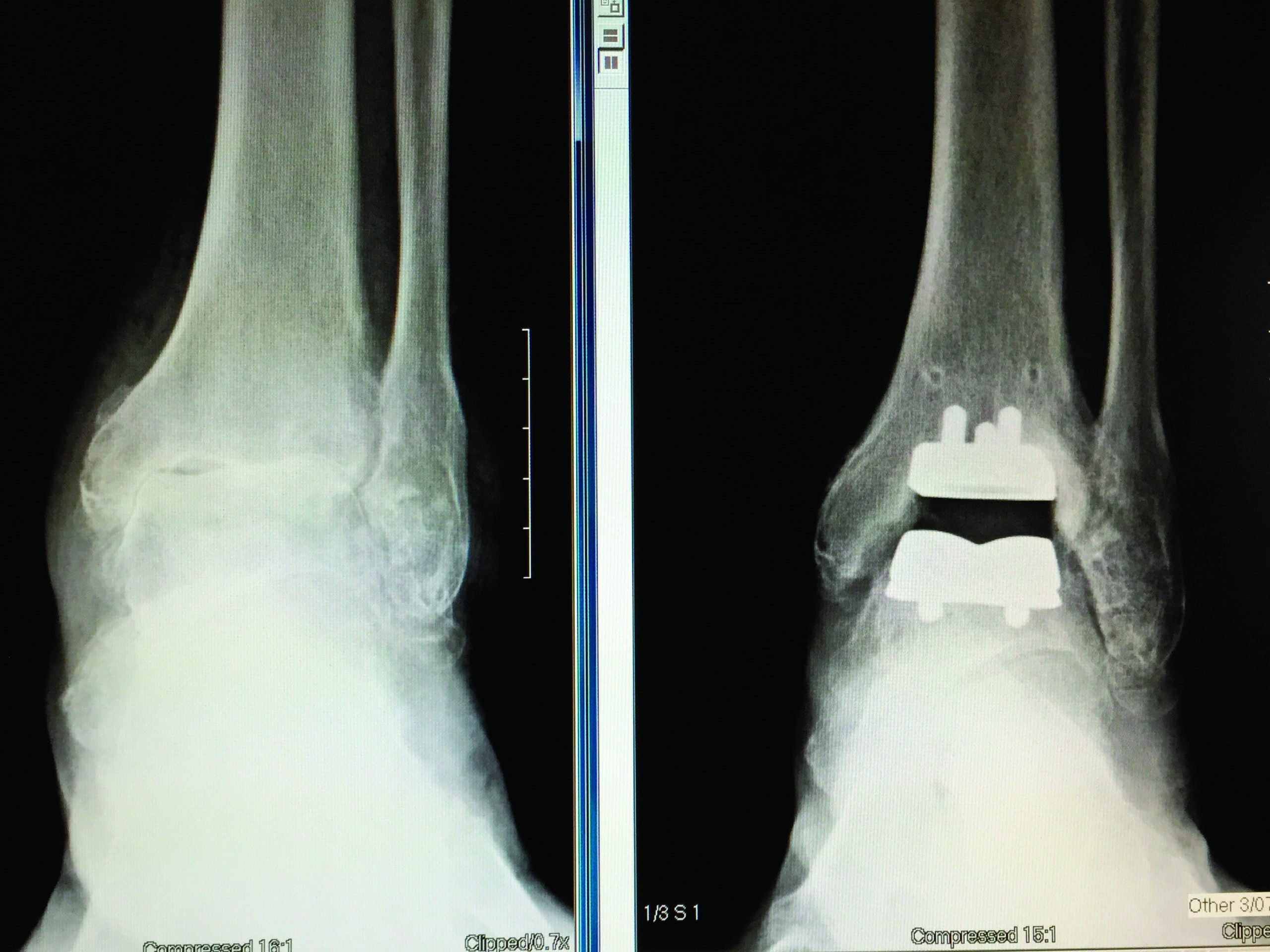 Ankle Replacement Surgery Md Update