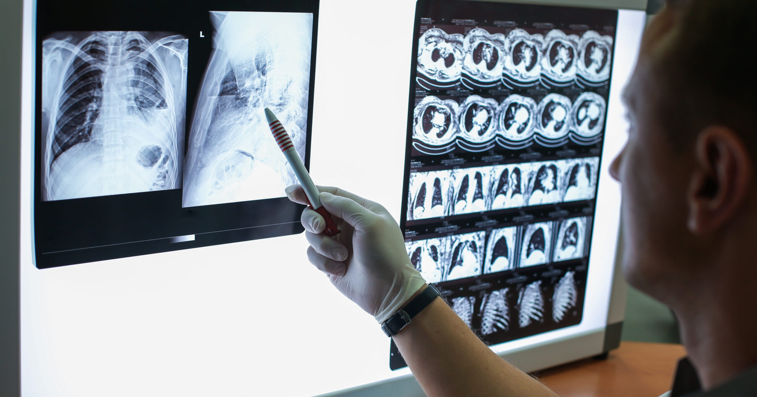 Carrying out a description of the radiographs of a patient with COPD