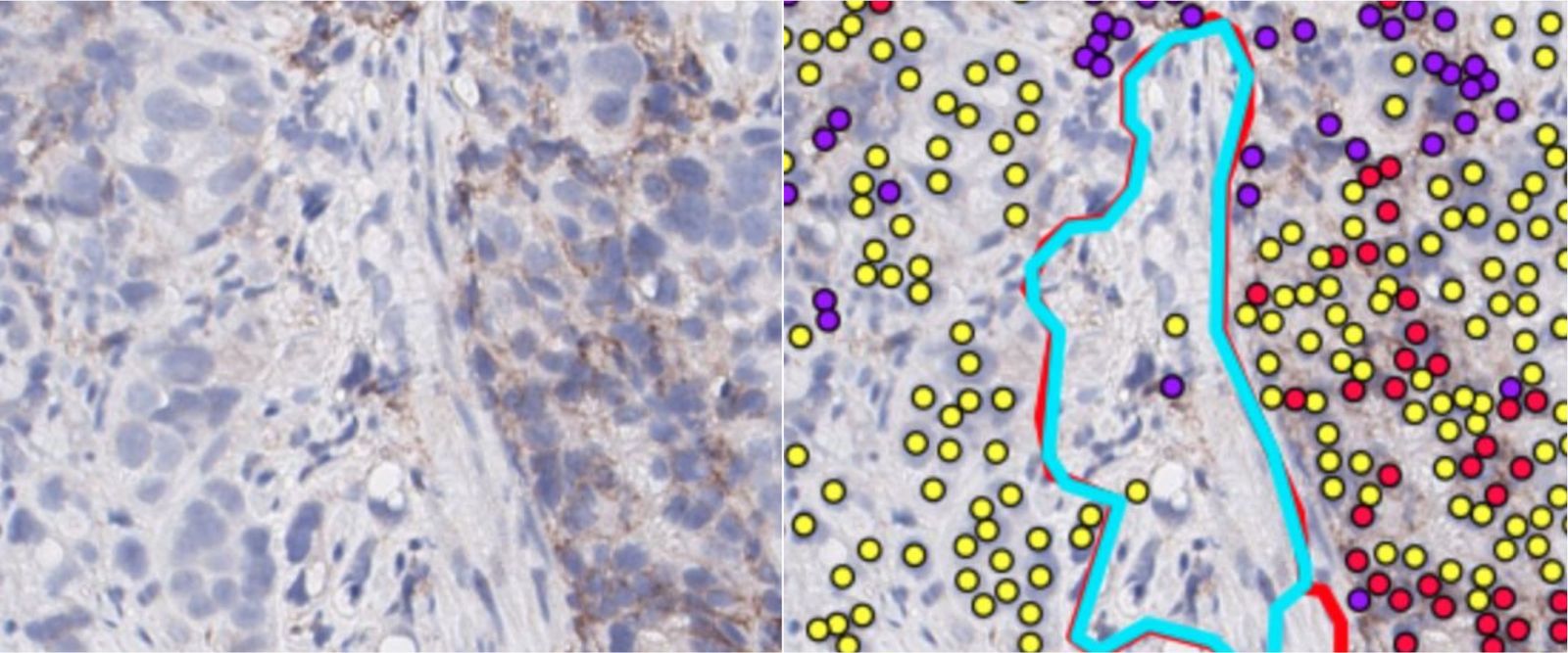 Her2 IHC stain before and after AI cell scoring
