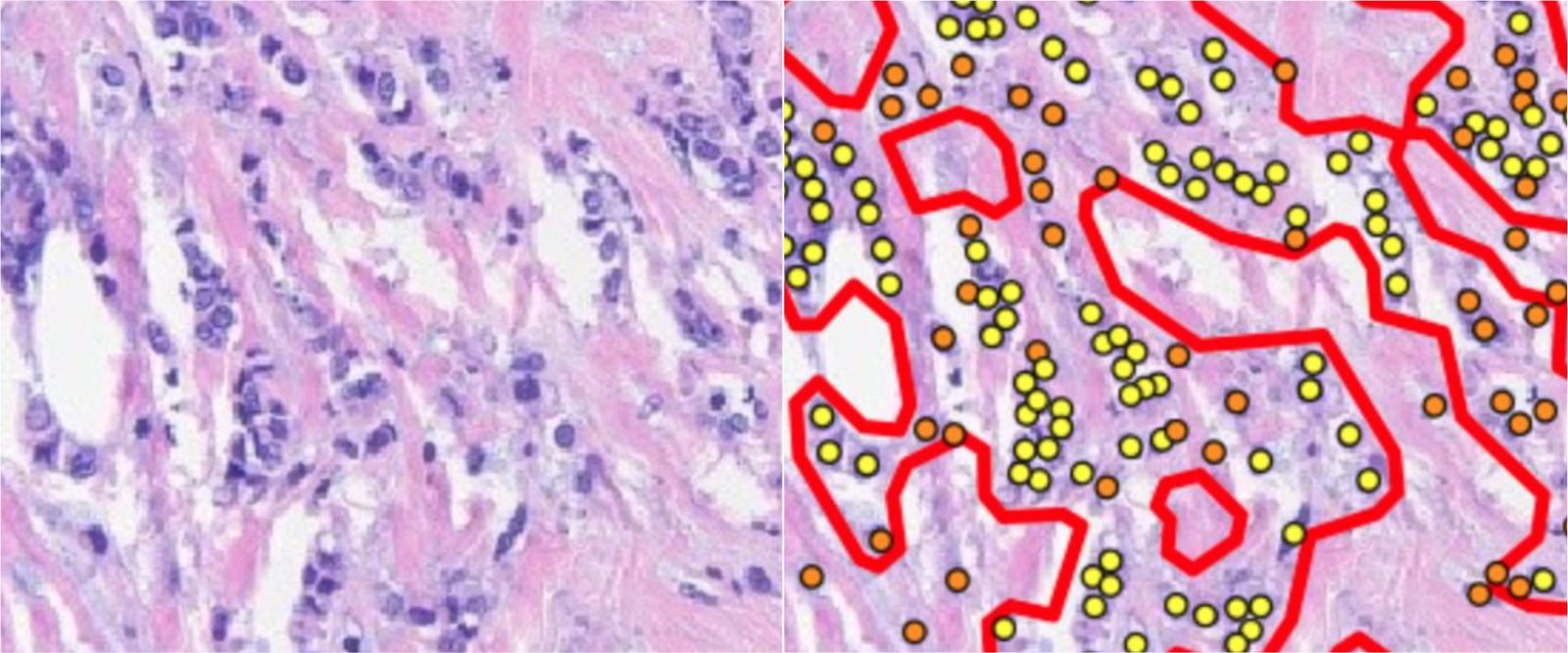 Breast tissue before and after AI highlights cancer cells
