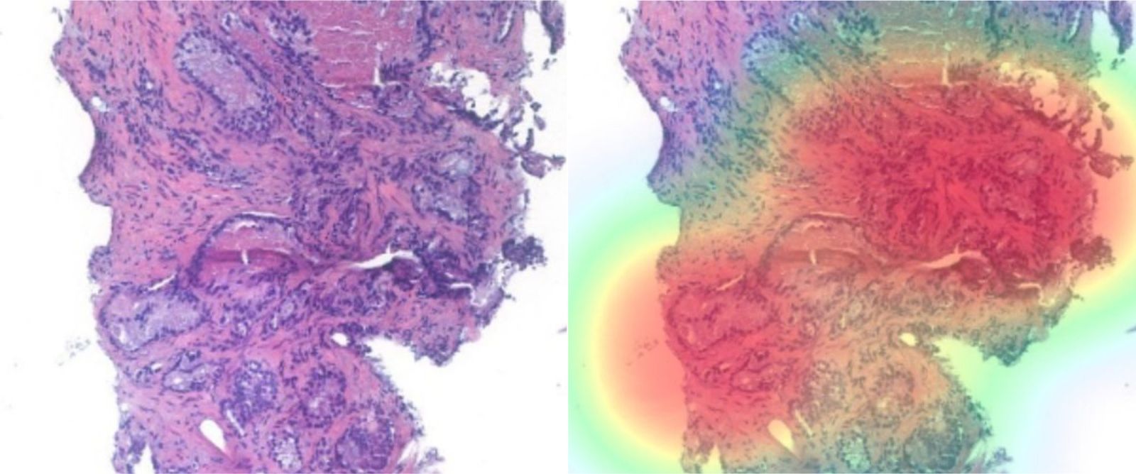 Prostate tissue before and after an AI heat map of cancer areas